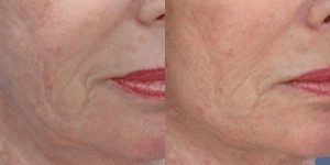 thermascan skin firming result