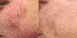 thermascan acne treatment result 3