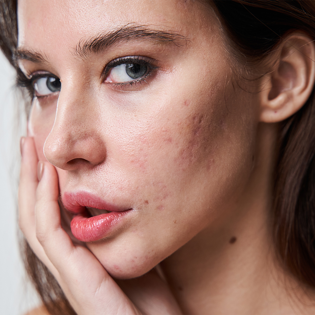 Photo of a woman with acne and acne scars on her face