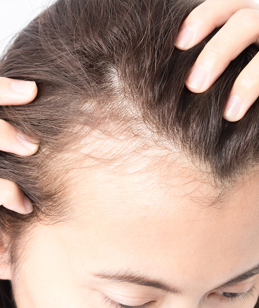 Photo of a woman's thinning hair and hair loss along her scalp