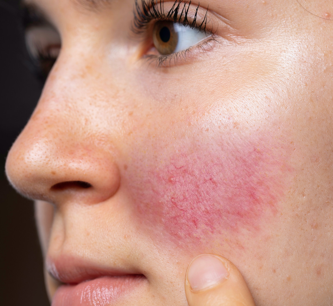 Photo of rosacea on a woman's face