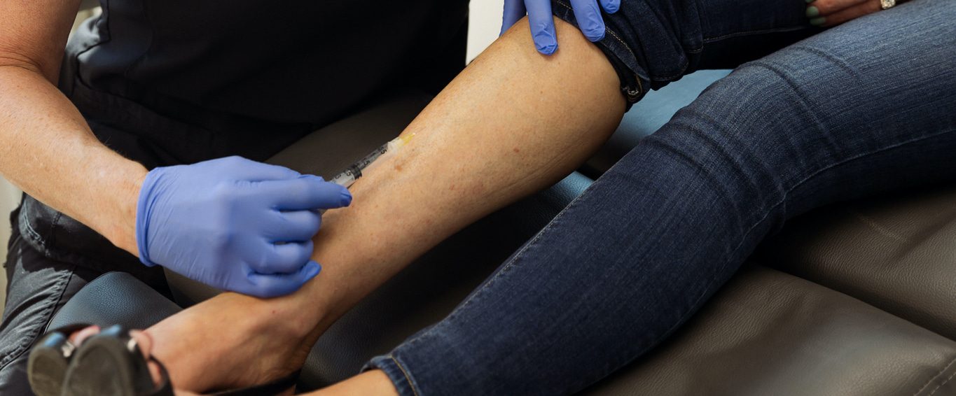 Leg Vein Removal