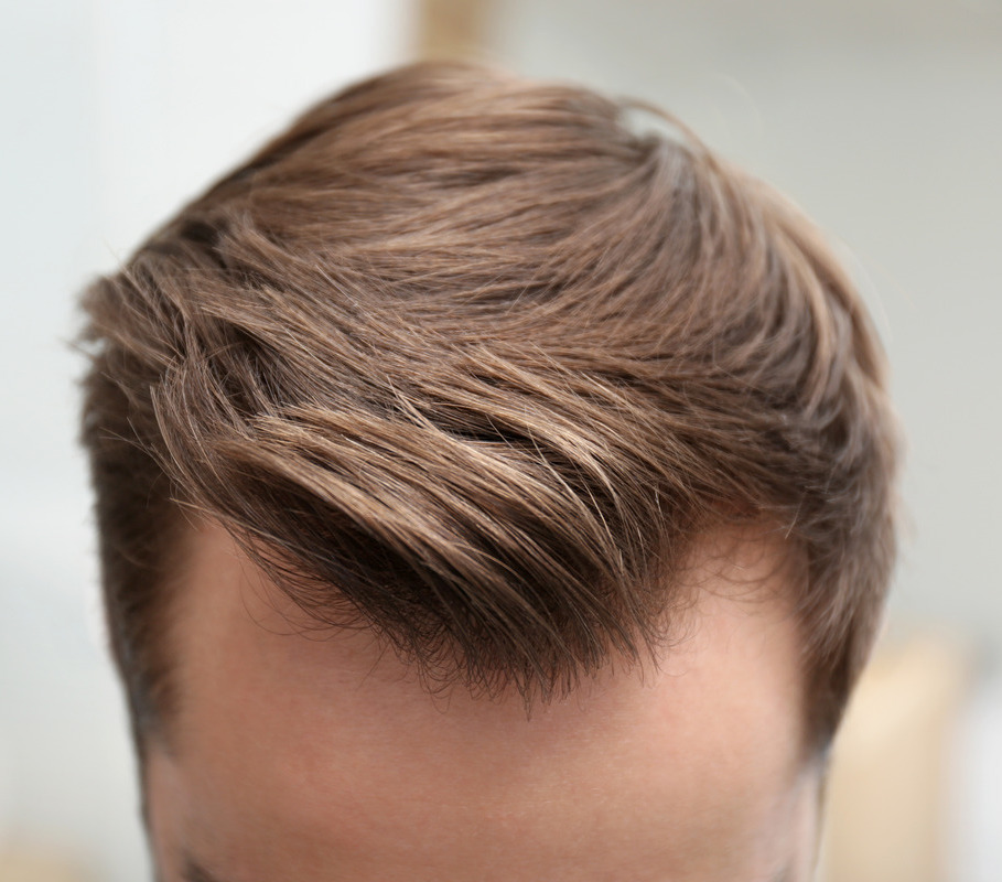 Photo of a man's hair and hairline after hair restoration treatments