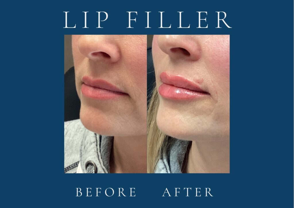 Before and after dermal filler results