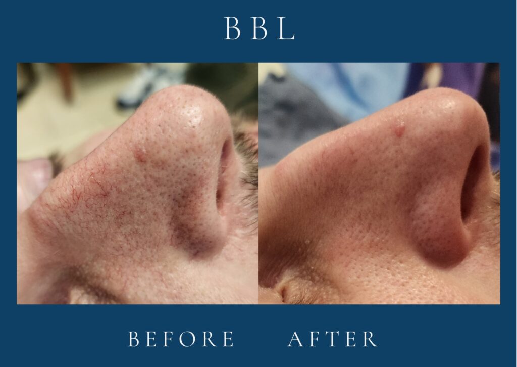 Before and after BBL results